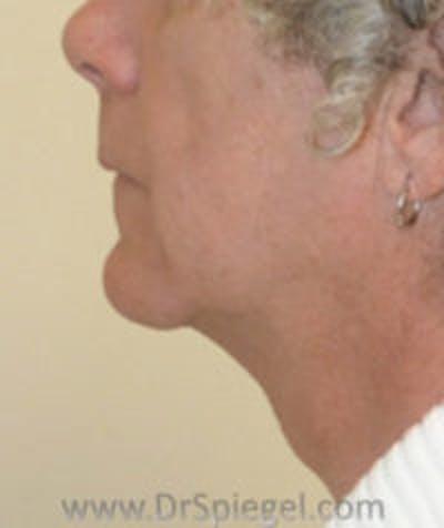 FFS Trachea Shave Before & After Gallery - Patient 393502 - Image 1