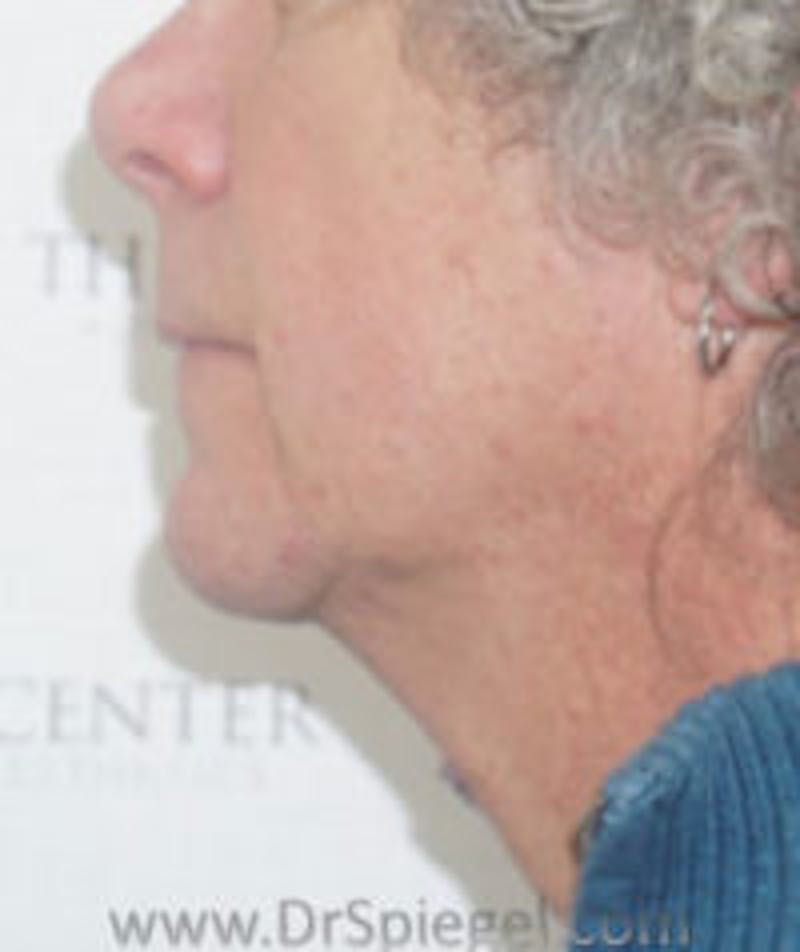 FFS Trachea Shave Before & After Gallery - Patient 393502 - Image 2