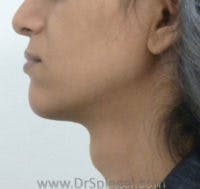 FFS Trachea Shave Before & After Gallery - Patient 362525 - Image 1
