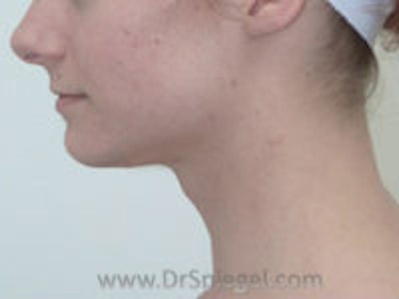 FFS Trachea Shave Before & After Gallery - Patient 211347 - Image 1
