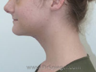 FFS Trachea Shave Before & After Gallery - Patient 211347 - Image 2