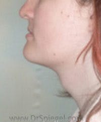FFS Trachea Shave Before & After Gallery - Patient 484409 - Image 1
