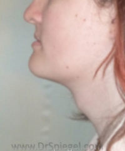 FFS Trachea Shave Before & After Gallery - Patient 484409 - Image 1