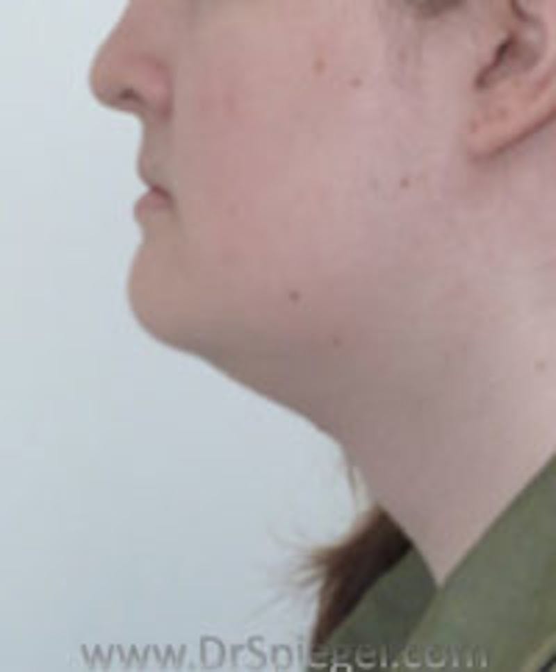 FFS Trachea Shave Before & After Gallery - Patient 484409 - Image 2