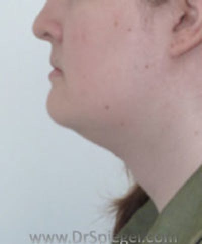 FFS Trachea Shave Before & After Gallery - Patient 484409 - Image 2