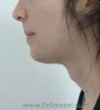 FFS Trachea Shave Before & After Gallery - Patient 341236 - Image 1