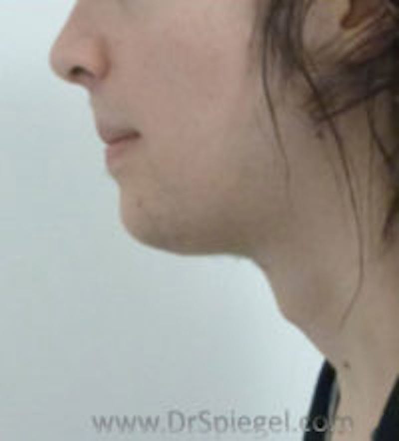 FFS Trachea Shave Before & After Gallery - Patient 341236 - Image 1