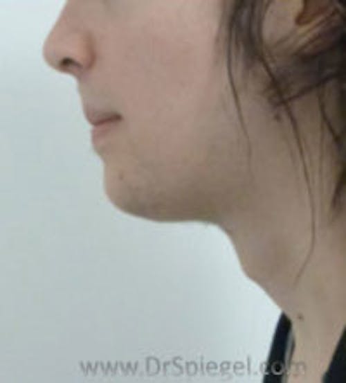 FFS Trachea Shave Before & After Gallery - Patient 341236 - Image 1