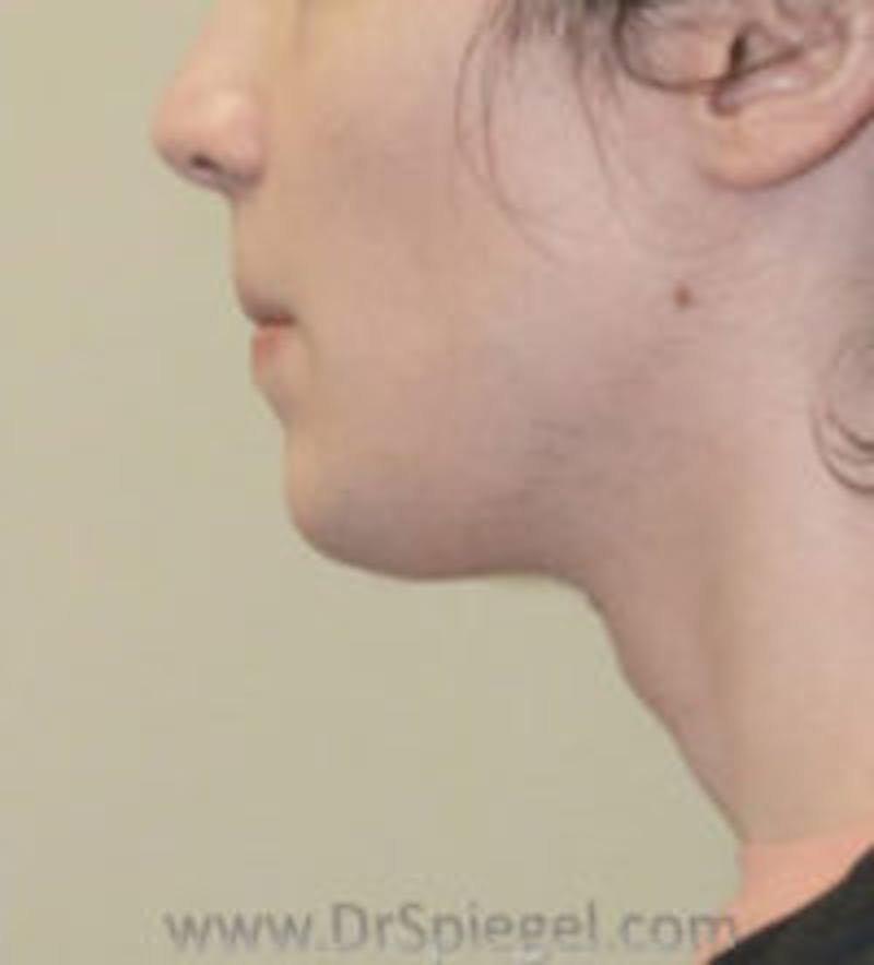 FFS Trachea Shave Before & After Gallery - Patient 341236 - Image 2