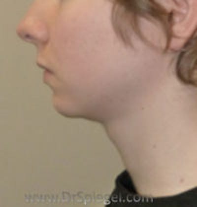 FFS Trachea Shave Before & After Gallery - Patient 954611 - Image 2