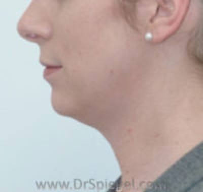 FFS Trachea Shave Before & After Gallery - Patient 381485 - Image 2