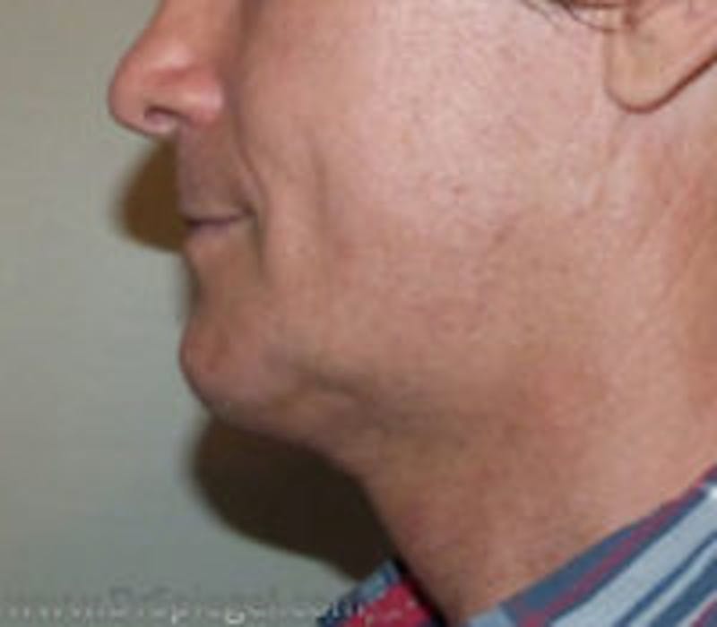 FFS Trachea Shave Before & After Gallery - Patient 346307 - Image 2