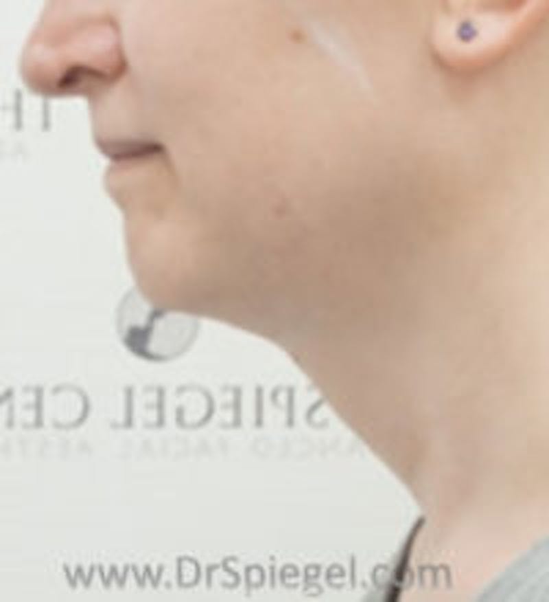 FFS Trachea Shave Before & After Gallery - Patient 384986 - Image 2