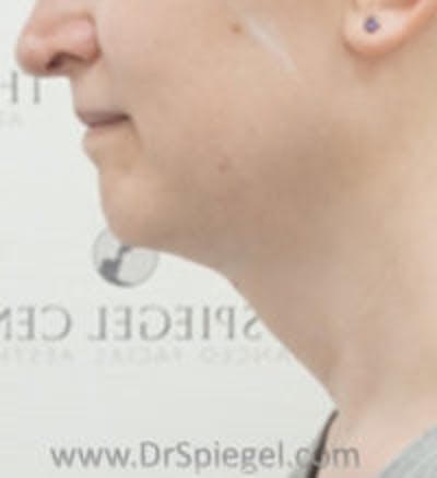 FFS Trachea Shave Before & After Gallery - Patient 384986 - Image 2