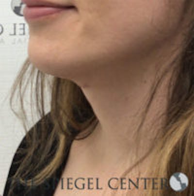 FFS Trachea Shave Before & After Gallery - Patient 448750 - Image 2