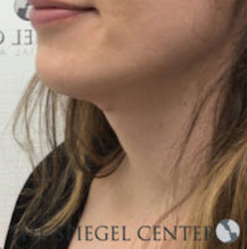 FFS Trachea Shave Before & After Gallery - Patient 448750 - Image 2
