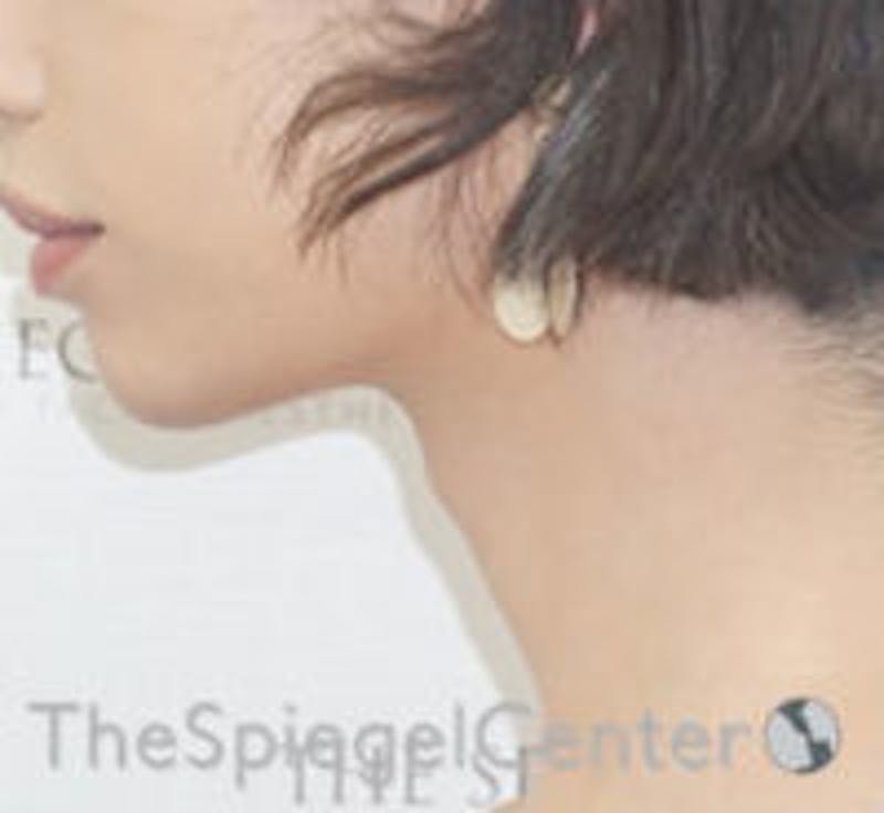 FFS Trachea Shave Before & After Gallery - Patient 181237 - Image 2