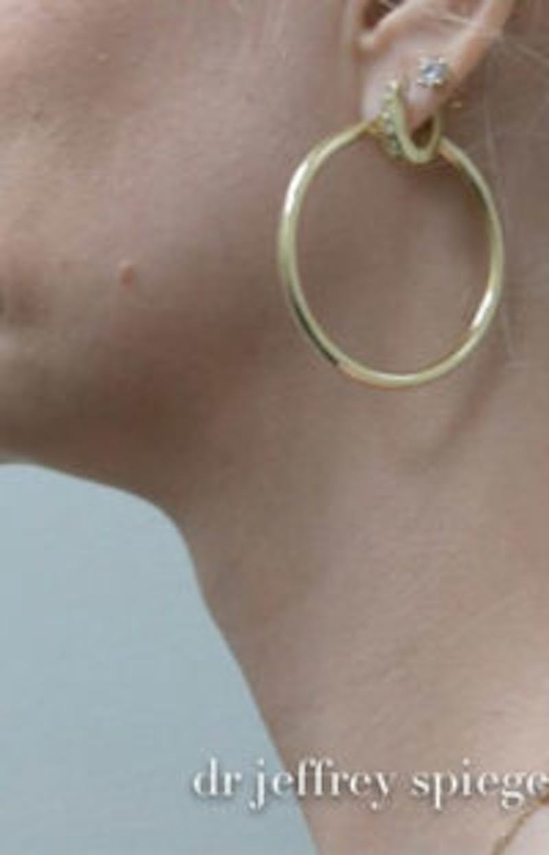 FFS Trachea Shave Before & After Gallery - Patient 427467 - Image 1