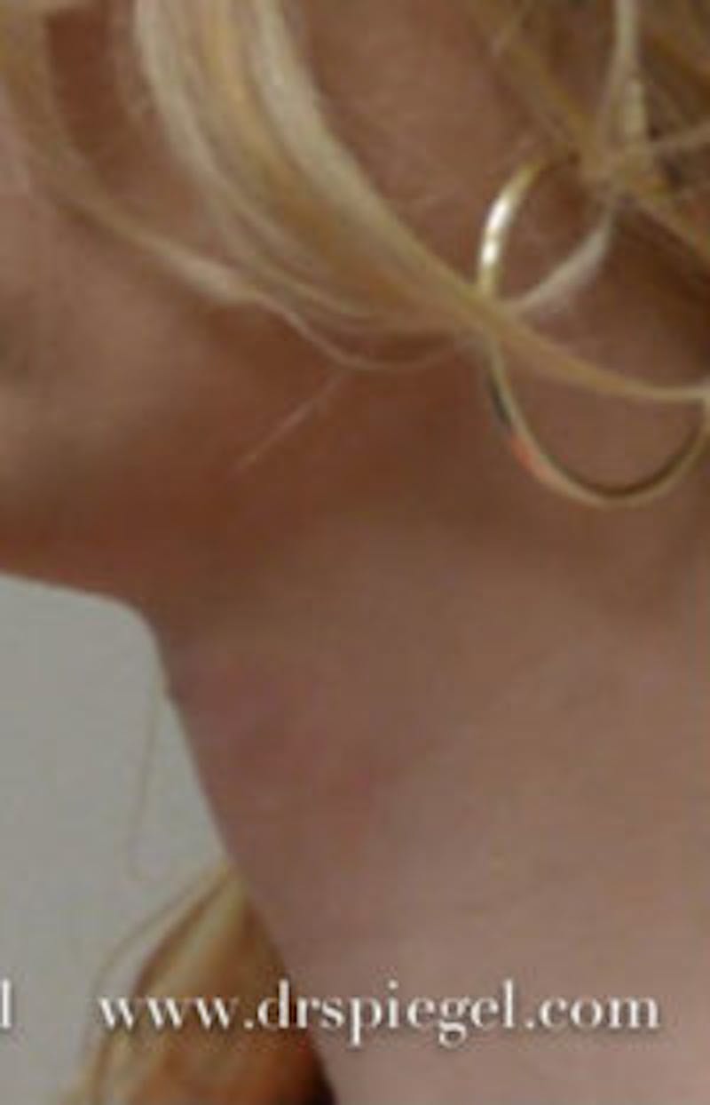 FFS Trachea Shave Before & After Gallery - Patient 427467 - Image 2