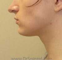 FFS Trachea Shave Before & After Gallery - Patient 306877 - Image 1