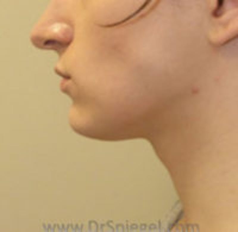 FFS Trachea Shave Before & After Gallery - Patient 306877 - Image 1