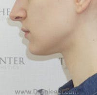 FFS Trachea Shave Before & After Gallery - Patient 306877 - Image 2