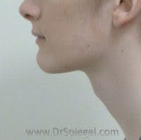 FFS Trachea Shave Before & After Gallery - Patient 260921 - Image 1