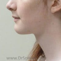 FFS Trachea Shave Before & After Gallery - Patient 260921 - Image 2