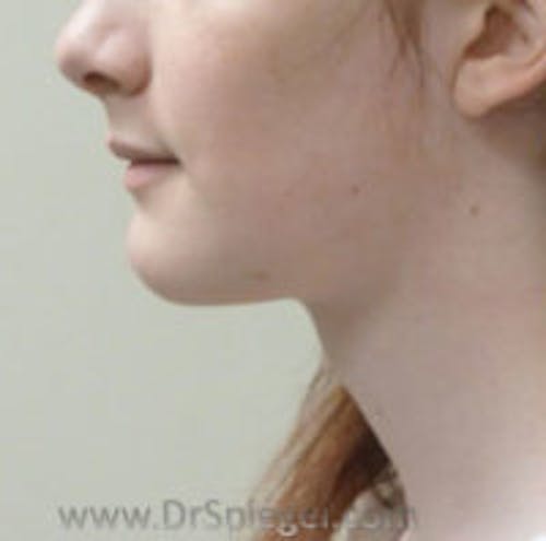 FFS Trachea Shave Before & After Gallery - Patient 260921 - Image 2