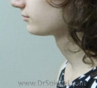 FFS Trachea Shave Before & After Gallery - Patient 281409 - Image 1