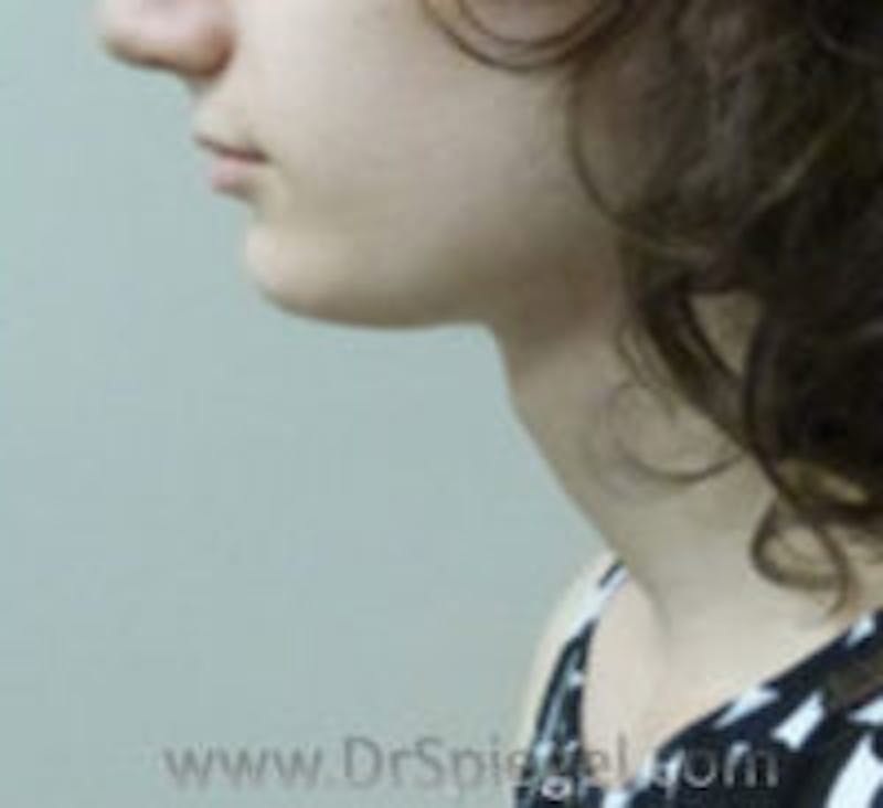 FFS Trachea Shave Before & After Gallery - Patient 281409 - Image 1