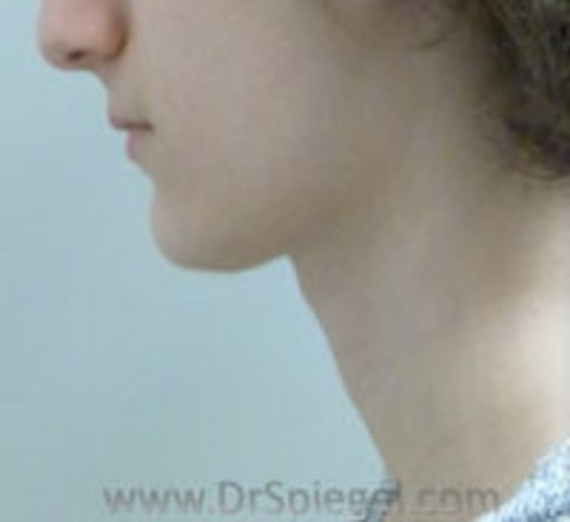 FFS Trachea Shave Before & After Gallery - Patient 281409 - Image 2