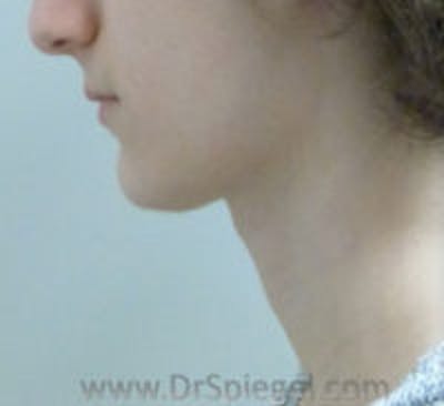 FFS Trachea Shave Before & After Gallery - Patient 281409 - Image 2