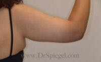 Arm Lift Before & After Gallery - Patient 406009 - Image 2