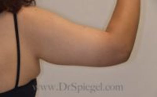 Arm Lift Before & After Gallery - Patient 406009 - Image 2