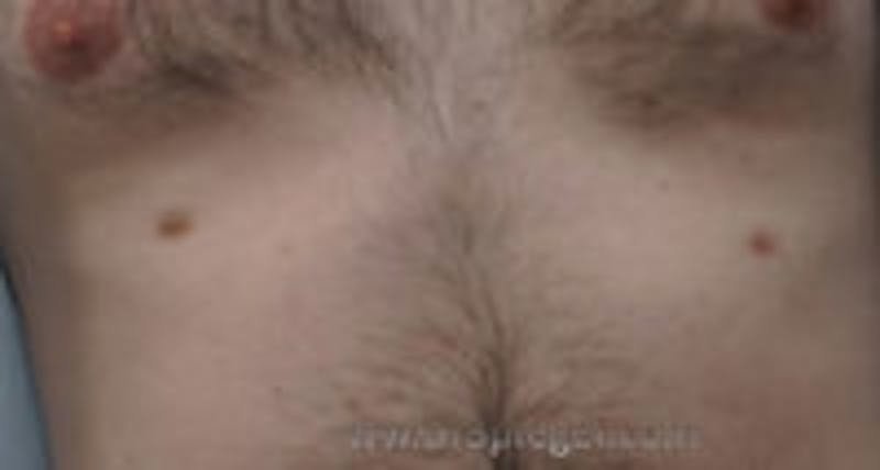 Extra Nipple Removal Before & After Gallery - Patient 228719 - Image 1