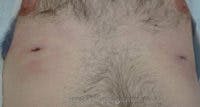 Extra Nipple Removal Before & After Gallery - Patient 228719 - Image 2
