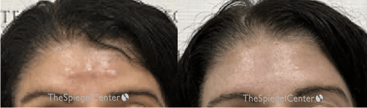 Scar Revision Before & After Gallery - Patient 390434 - Image 1