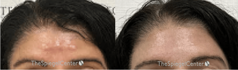 Scar Revision Before & After Gallery - Patient 390434 - Image 1