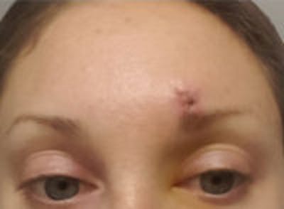 Scar Revision Before & After Gallery - Patient 837937 - Image 1