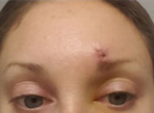 Scar Revision Before & After Gallery - Patient 837937 - Image 1