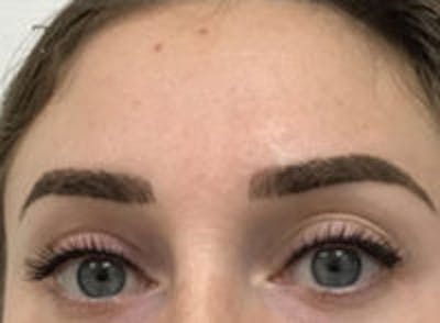 Scar Revision Before & After Gallery - Patient 837937 - Image 2