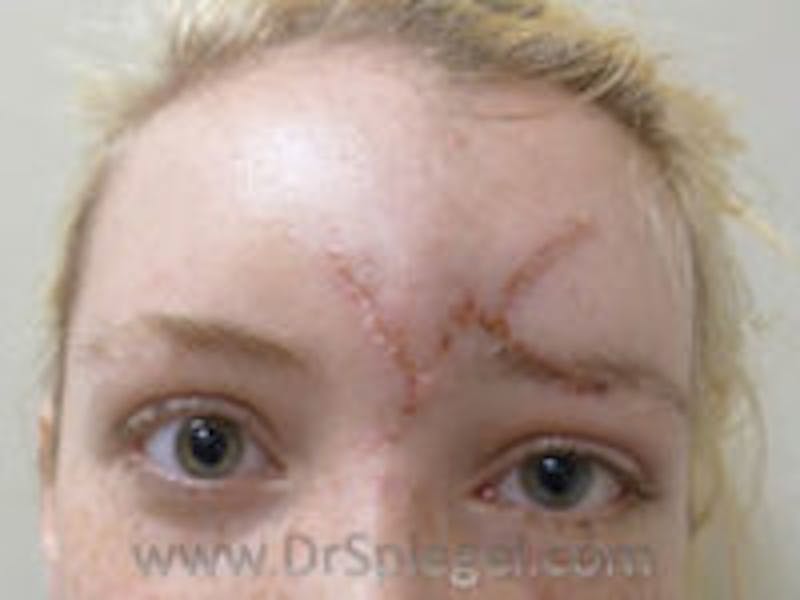 Scar Revision Before & After Gallery - Patient 129764 - Image 1