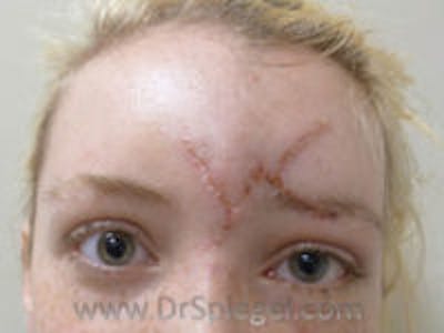 Scar Revision Before & After Gallery - Patient 129764 - Image 1