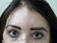 Scar Revision Before & After Gallery - Patient 129764 - Image 2