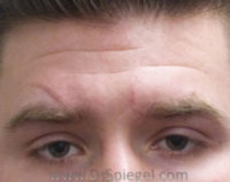 Scar Revision Before & After Gallery - Patient 396185 - Image 1