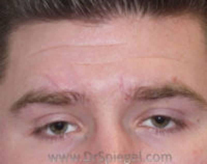 Scar Revision Before & After Gallery - Patient 396185 - Image 2