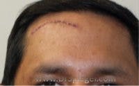 Scar Revision Before & After Gallery - Patient 123226 - Image 1
