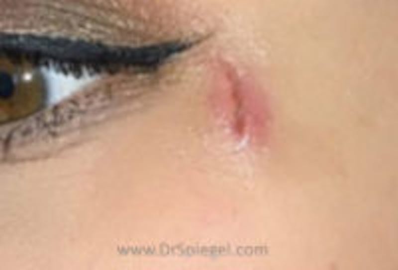 Scar Revision Before & After Gallery - Patient 111366 - Image 1