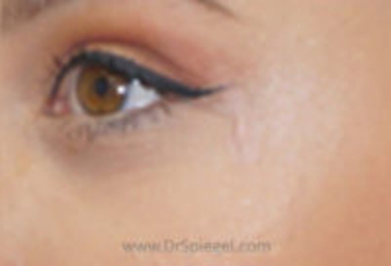 Scar Revision Before & After Gallery - Patient 111366 - Image 2